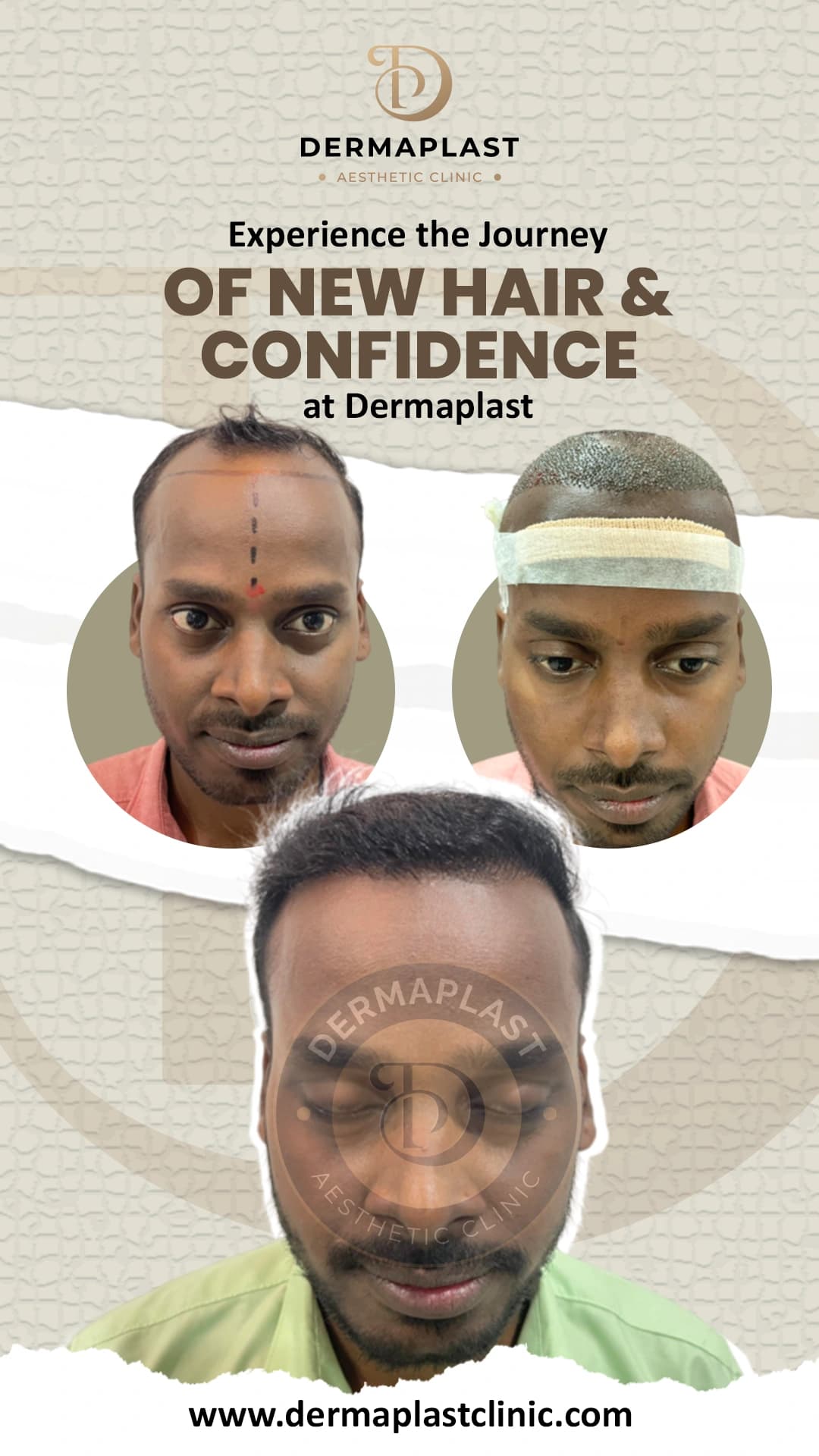 Hair transplant result at Dermaplast — case 6 of 6: the same patient before the procedure, immediately after, and at follow-up. Procedure 14 April.